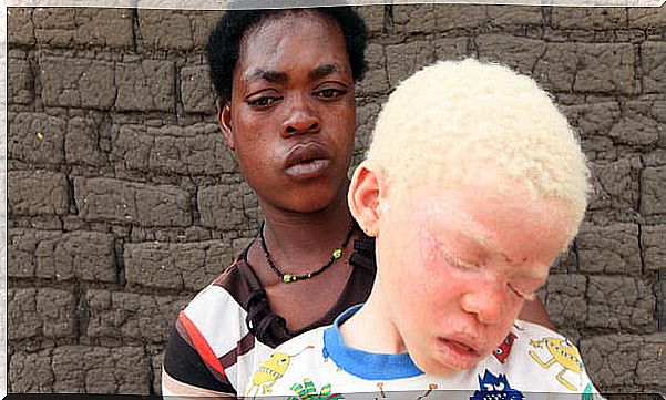 African mom with her son representing albino people